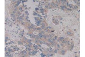 IHC-P analysis of Human Breast Cancer Tissue, with DAB staining. (MAP2K6 antibody  (AA 46-306))
