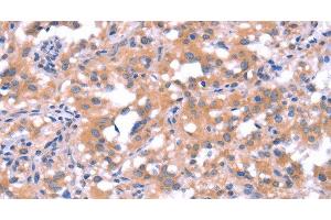 Immunohistochemistry of paraffin-embedded Human thyroid cancer tissue using FAT1 Polyclonal Antibody at dilution 1:40 (FAT1 antibody)