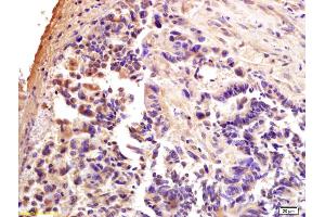 Formalin-fixed and paraffin embedded human rectal carcinoma labeled with Anti-CTCF Polyclonal Antibody, Unconjugated (ABIN703976) at 1:200 followed by conjugation to the secondary antibody and DAB staining. (CTCF antibody  (AA 451-550))