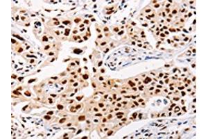 The image on the left is immunohistochemistry of paraffin-embedded Human lung cancer tissue using ABIN7128323(AKAP8L Antibody) at dilution 1/20, on the right is treated with fusion protein. (AKAP8L antibody)