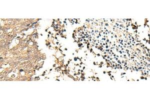 Immunohistochemistry of paraffin-embedded Human lung cancer tissue using CHP1 Polyclonal Antibody at dilution of 1:25(x200) (CHP antibody)