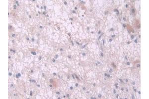 Detection of IL2 in Human Glioma Tissue using Polyclonal Antibody to Interleukin 2 (IL2) (IL-2 antibody  (AA 21-153))