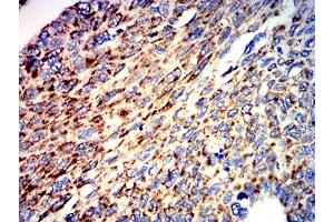 Immunohistochemical analysis of paraffin-embedded lung cancer tissues using ATPIF1 mouse mAb with DAB staining.