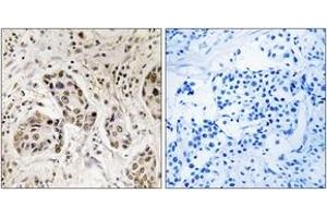 Immunohistochemistry analysis of paraffin-embedded human breast carcinoma tissue, using RCC2 Antibody. (RCC2 antibody  (AA 473-522))
