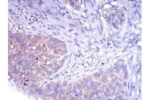 Immunohistochemical analysis of paraffin-embedded cervical cancer tissues using TH mouse mAb with DAB staining. (TH antibody  (AA 44-208))