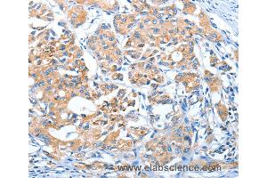 Immunohistochemistry of Human lung cancer using AUP1 Polyclonal Antibody at dilution of 1:50