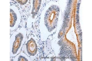 Immunohistochemistry of Human colon cancer using PLAUR Polyclonal Antibody at dilution of 1:50