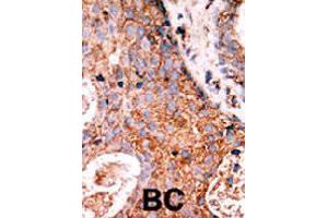 Formalin-fixed and paraffin-embedded human cancer tissue reacted with LMTK2 polyclonal antibody  , which was peroxidase-conjugated to the secondary antibody, followed by DAB staining. (LMTK2 antibody  (N-Term))