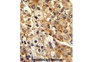 Formalin-fixed and paraffin-embedded human hepatocarcinoma reacted with ATP1B2 Antibody (Center), which was peroxidase-conjugated to the secondary antibody, followed by DAB staining. (ATP1B2 antibody  (Middle Region))