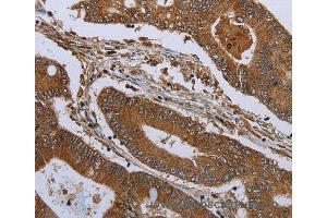 Immunohistochemistry of Human colon cancer using KLRF1 Polyclonal Antibody at dilution of 1:30