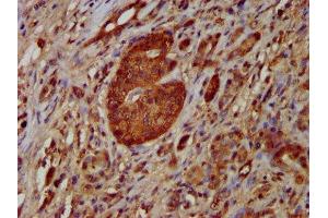 IHC image of ABIN7161669 diluted at 1:100 and staining in paraffin-embedded human pancreatic cancer performed on a Leica BondTM system. (NOMO1 antibody  (AA 918-1044))