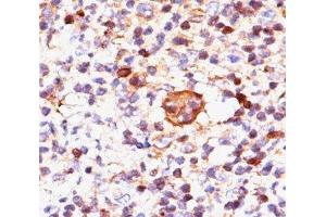 IHC testing of Hodgkin's lymphoma stained with Bax antibody (Clone 2D2). (BAX antibody)