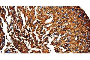 Immunohistochemistry of paraffin-embedded Human lung cancer using PKM Polyclonal Antibody at dilution of 1:50 (PKM antibody)