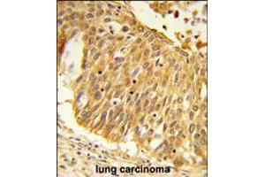 Formalin-fixed and paraffin-embedded human lung carcinoma reacted with EEFSEC Antibody , which was peroxidase-conjugated to the secondary antibody, followed by DAB staining.