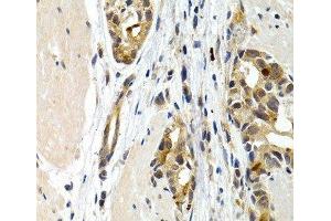 Immunohistochemistry of paraffin-embedded Human stomach cancer using IL9 Polyclonal Antibody at dilution of 1:200 (40x lens). (IL-9 antibody)