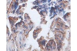 Immunohistochemical staining of formalin-fixed paraffin-embedded human colon carcinoma tissue staining with ANXA2 polyclonal antibody  at 1 : 100 dilution. (Annexin A2 antibody  (AA 177-329))