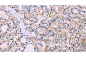 Immunohistochemistry of paraffin-embedded Human thyroid cancer tissue using ADCY5 Polyclonal Antibody at dilution 1:30 (ADCY5 antibody)