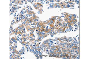 Immunohistochemistry of Human lung cancer using CCL6 Polyclonal Antibody at dilution of 1:50 (CCL6 antibody)
