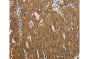 Immunohistochemistry of Human ovarian cancer using NIT2 Polyclonal Antibody at dilution of 1:40