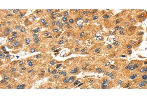 Immunohistochemistry of paraffin-embedded Human liver cancer tissue using SH3KBP1 Polyclonal Antibody at dilution 1:45 (SH3KBP1 antibody)