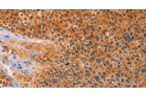 Immunohistochemistry of paraffin-embedded Human liver cancer tissue using ADHFE1 Polyclonal Antibody at dilution 1:30 (ADHFE1 antibody)