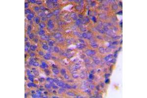 Immunohistochemical analysis of CBR1 staining in human breast cancer formalin fixed paraffin embedded tissue section.