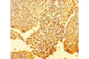 Immunohistochemistry of paraffin-embedded human cervical cancer using ABIN7168303 at dilution of 1:100