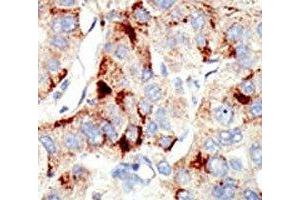 IHC analysis of FFPE human hepatocarcinoma stained with the Dnmt2 antibody (Dnmt2 antibody  (AA 201-230))