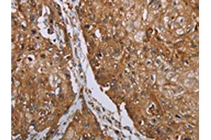 The image on the left is immunohistochemistry of paraffin-embedded Human esophagus cancer tissue using ABIN7192846(TNPO1 Antibody) at dilution 1/25, on the right is treated with synthetic peptide. (Transportin 1 antibody)