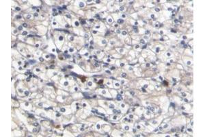 DAB staining on IHC-P; Samples: Human Renal cancer Tissue (S100A8 antibody  (AA 1-93))