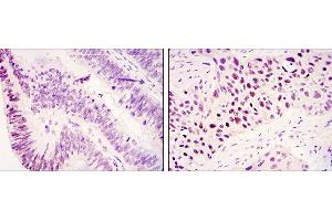 Immunohistochemical analysis of paraffin-embedded colonic cancer tissues (left) and lung cancer tissues (right) using KDM3A mouse mAb with DAB staining. (KDM3A antibody)