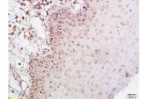 Formalin-fixed and paraffin embedded human laryngeal cancer labeled with Anti-CD44v5 Polyclonal Antibody, Unconjugated (ABIN680623) at 1:200 followed by conjugation to the secondary antibody (CD44RC (AA 61-139) antibody)