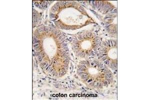 Formalin-fixed and paraffin-embedded human colon carcinoma tissue reacted with FGF1 antibody (N-term) (ABIN390361 and ABIN2840769) , which was peroxidase-conjugated to the secondary antibody, followed by DAB staining. (FGF1 antibody  (N-Term))