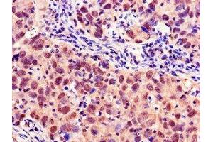 Immunohistochemistry of paraffin-embedded human pancreatic cancer using ABIN7160378 at dilution of 1:100 (MYBL2 antibody  (AA 188-366))