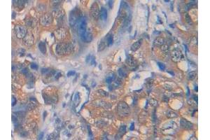 DAB staining on IHC-P; Samples: Human Breast cancer Tissue (IL1R1 antibody  (AA 226-318))