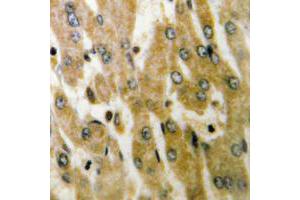 Immunohistochemical analysis of ACOT4 staining in human liver cancer formalin fixed paraffin embedded tissue section. (ACOT4 antibody  (C-Term))