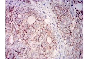 Immunohistochemical analysis of paraffin-embedded cervical cancer tissues using CD315 mouse mAb with DAB staining. (PTGFRN antibody  (AA 46-221))