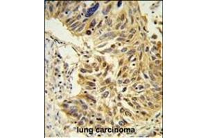 SDR Antibody (Center) (ABIN653890 and ABIN2843136) IHC analysis in formalin fixed and paraffin embedded lung carcinoma followed by peroxidase conjugation of the secondary antibody and DAB staining. (SDPR antibody  (AA 109-135))