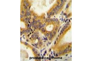 CC85C Antibody (N-term) immunohistochemistry analysis in formalin fixed and paraffin embedded human prostate carcinoma followed by peroxidase conjugation of the secondary antibody and DAB staining.