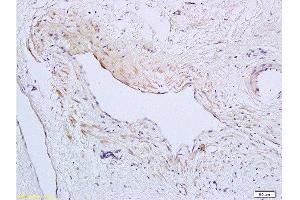 Formalin-fixed and paraffin embedded human cervical carcinoma tissue labeled with Anti-SynCAM/TSLC1 Polyclonal Antibody, Unconjugated  at 1:200 followed by conjugation to the secondary antibody and DAB staining (CADM1 antibody  (AA 365-442))