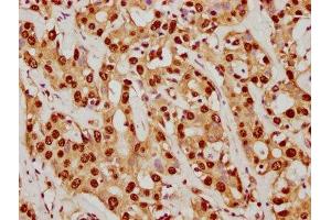 IHC image of ABIN7127830 diluted at 1:92. (Recombinant SUMO1 antibody)