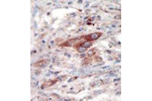 Formalin-fixed and paraffin-embedded human cancer tissue reacted with the primary antibody, which was peroxidase-conjugated to the secondary antibody, followed by DAB staining. (EPH Receptor B2 antibody  (N-Term))