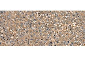 Immunohistochemistry of paraffin-embedded Human liver cancer tissue using CCDC85C Polyclonal Antibody at dilution of 1:30(x200) (CCDC85C antibody)