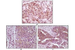 Immunohistochemical analysis of paraffin-embedded human pancreas carcinoma (A), esophagus carcinoma tissue (B) and ovary tumor tissue (C), showing cytoplasmic and membrane localization using 4E-BP1 mouse mAb with DAB staining. (eIF4EBP1 antibody)