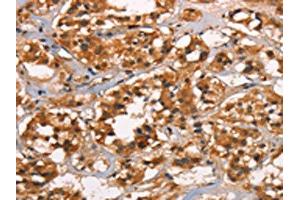 The image on the left is immunohistochemistry of paraffin-embedded Human thyroid cancer tissue using ABIN7190032(CABLES2 Antibody) at dilution 1/25, on the right is treated with synthetic peptide. (CABLES2 antibody)