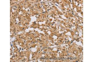 Immunohistochemistry of Human cervical cancer using DIDO1 Polyclonal Antibody at dilution of 1:50