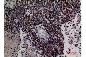Immunohistochemistry (IHC) analysis of paraffin-embedded Human Lung Cancer, antibody was diluted at 1:100. (DCI antibody  (C-Term))