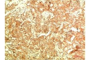Immunohistochemical analysis of paraffin-embedded Human Breast Carcinoma Tissue using ATG5 Mouse mAb diluted at 1:2000 (ATG5 antibody)