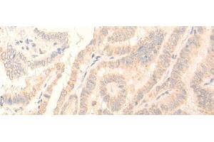 Immunohistochemistry of paraffin-embedded Human thyroid cancer tissue using ADGRE3 Polyclonal Antibody at dilution of 1:35(x200) (EMR3 antibody)