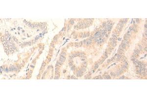 Immunohistochemistry of paraffin-embedded Human thyroid cancer tissue using ADGRE3 Polyclonal Antibody at dilution of 1:35(x200) (EMR3 antibody)